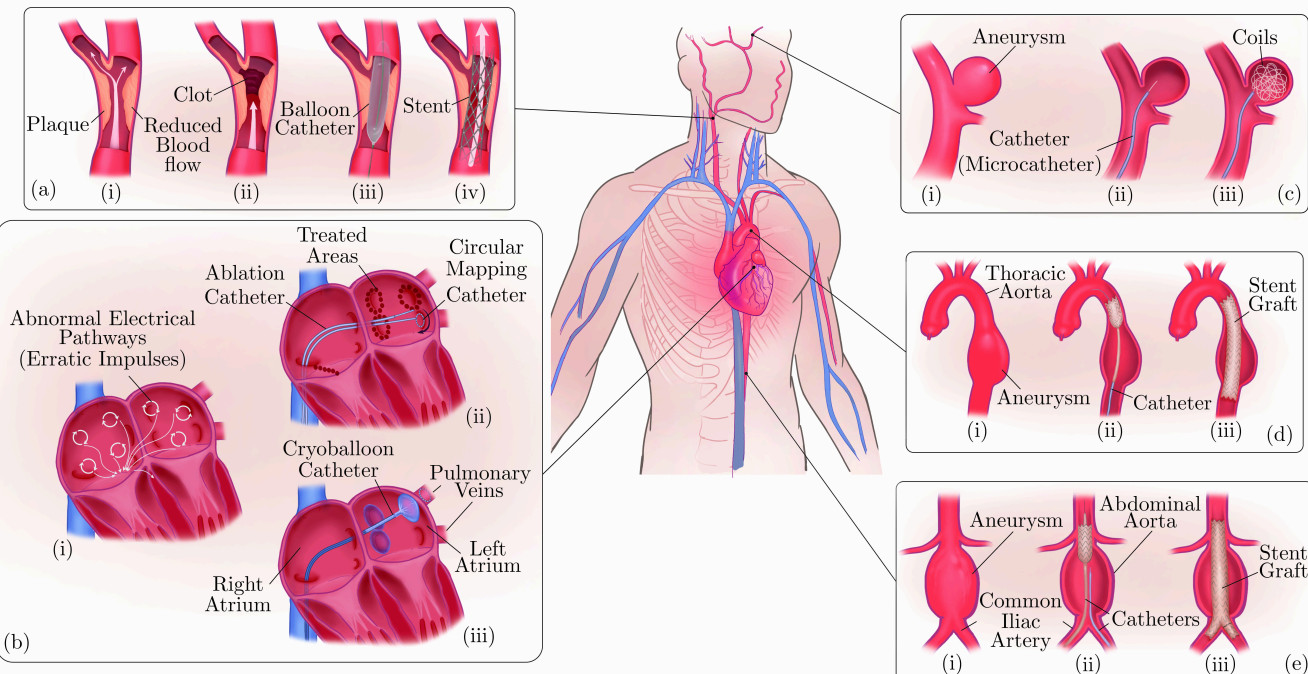 CVDs: (a) Carotid arteries stenosis: narrowing of the arteries on either side of the neck which carry blood to the head, face and brain. This narrowing is usually the result of build-up of plaque within the arteries, a condition called atherosclerosis. (b) Atrial fibrillation: irregular and often rapid heart rate. (c) Cerebral aneurysm: a bulged, weakened area of the cerebral artery wall. (d) Thoracic aortic aneurysm: bulging of the aorta which extends from the chest to the abdomen. (e) Abdominal aortic aneurysm: bulging of the lower part of the aorta (abdominal region).