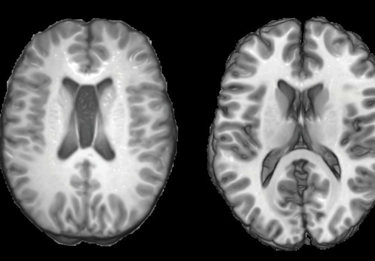 MRI scans from a traumatic brain injury patient (left) and a healthy person (right).