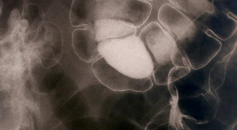 Catching bowel cancer early