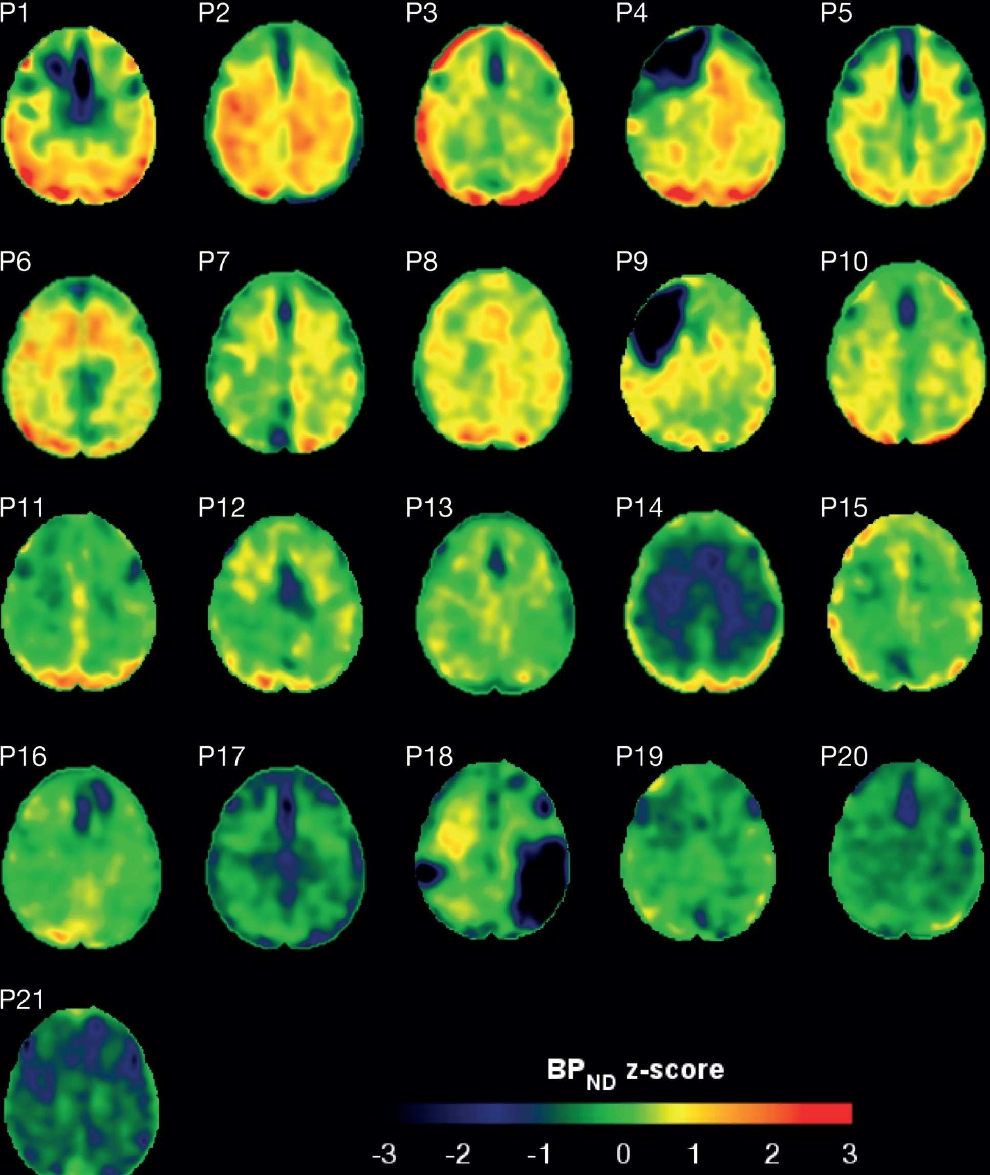 These scans show the amount of tau protein in the brains of patients who have suffered a traumatic brain injury. Red represents increased tau accumulation