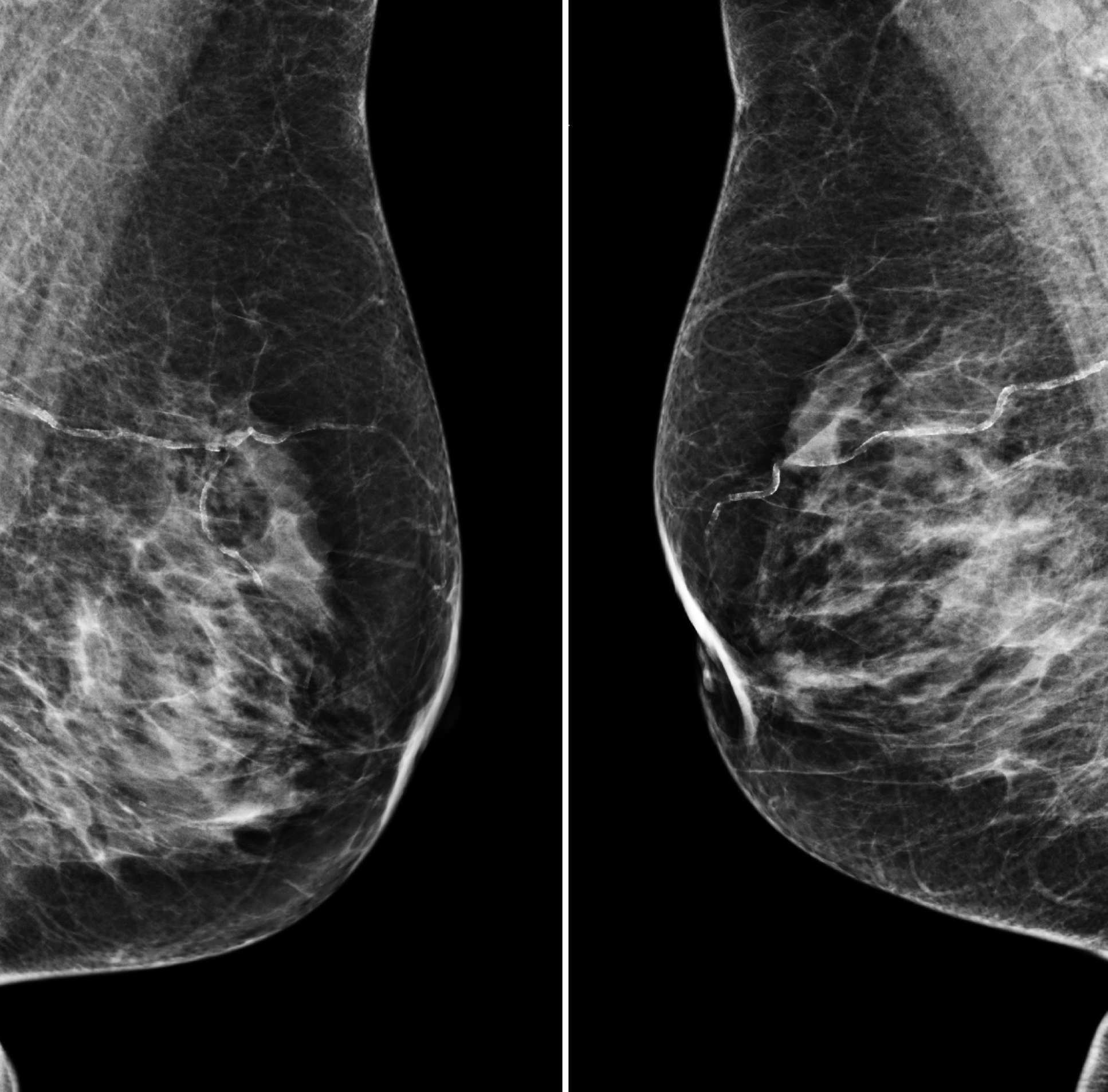 Image showing two mammograms side by side