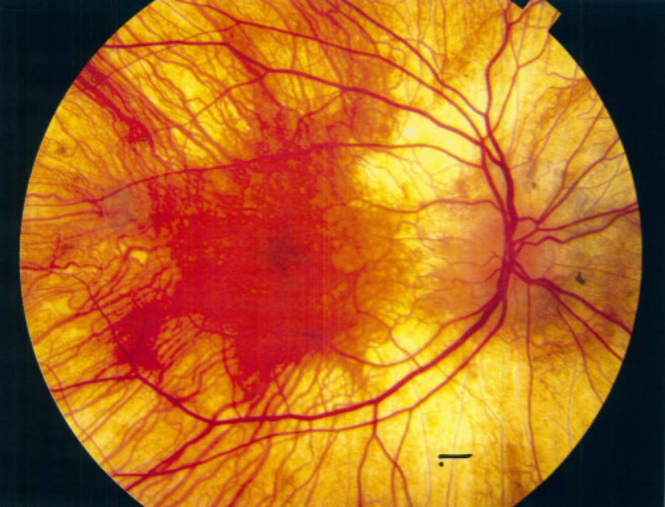 Scan of an eye with cloudy patches