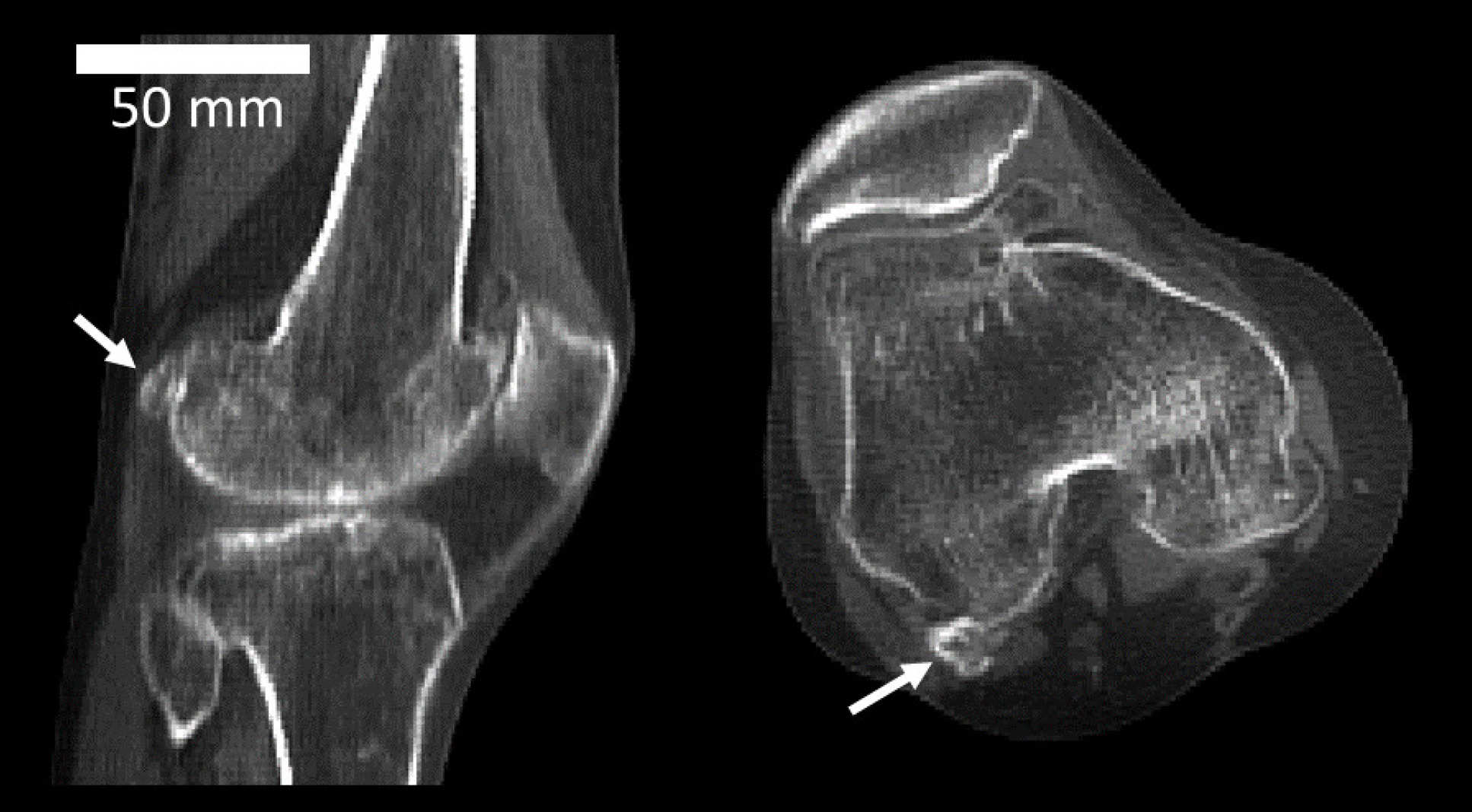 CT scan of a knee joint with fabella