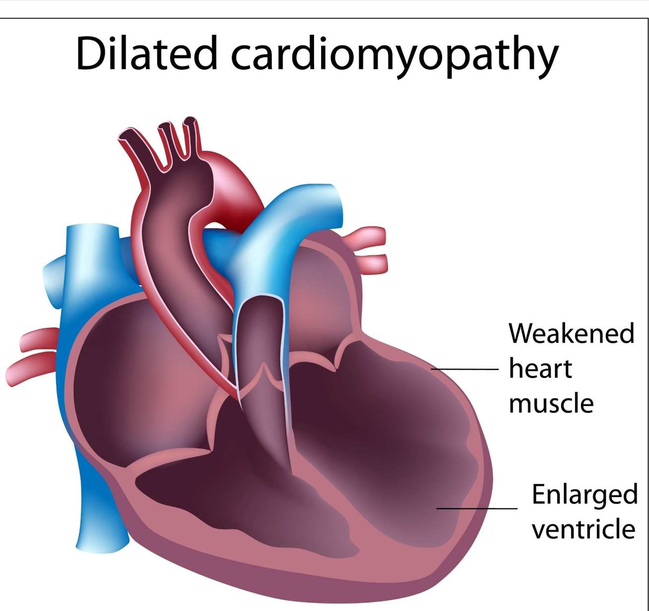 Dilated cardiomyopathy illustration