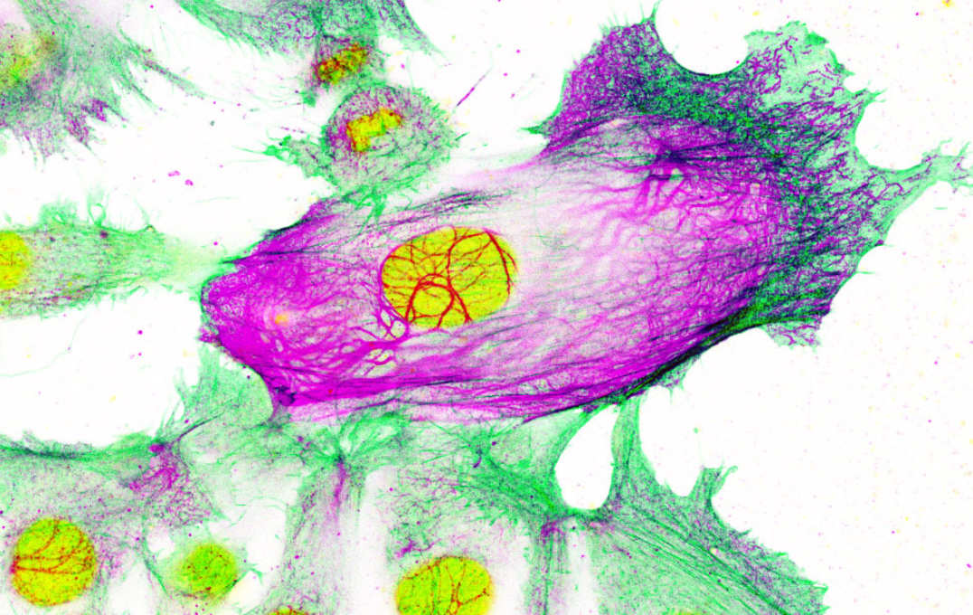 Drug-resistant breast cancer cells surrounded by non-resistant cells. The cell nucleus is shown in yellow, while the cell’s ‘scaffolding’ is shown in green and purple. Keratin-80 is shown in purple.