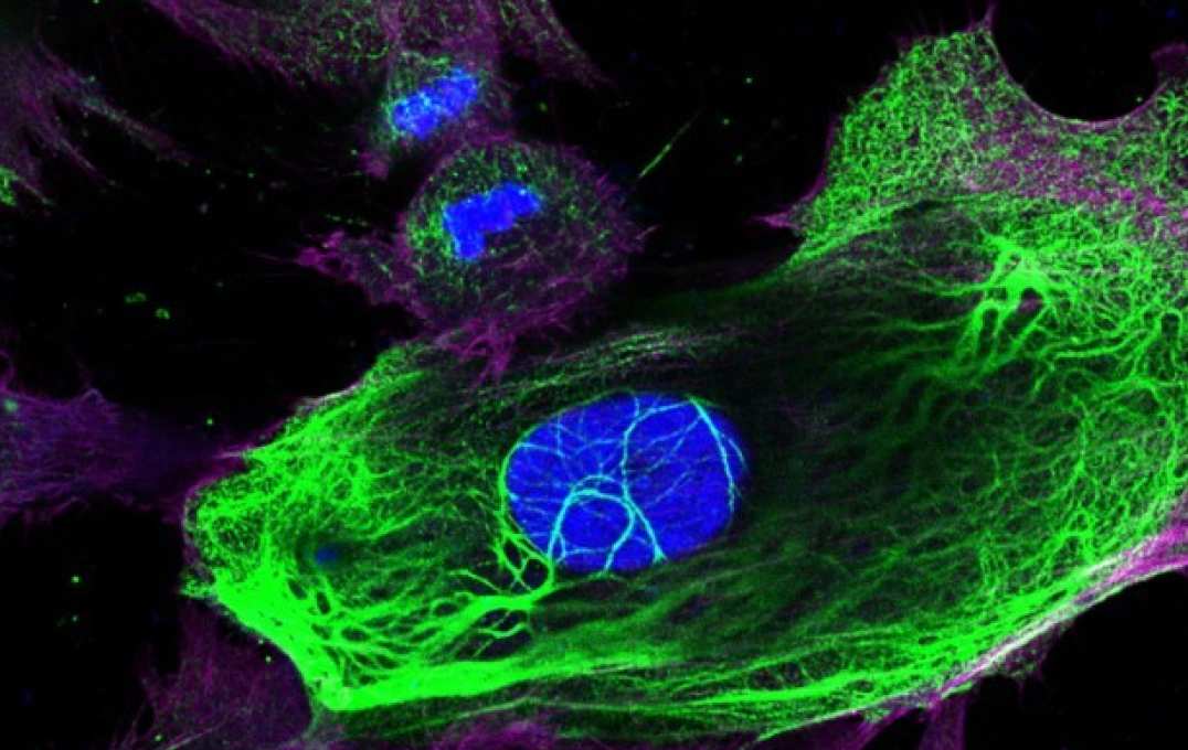 Drug-resistant breast cancer cells. The cell nucleus is in blue, with Keratin-80 shown in green. 