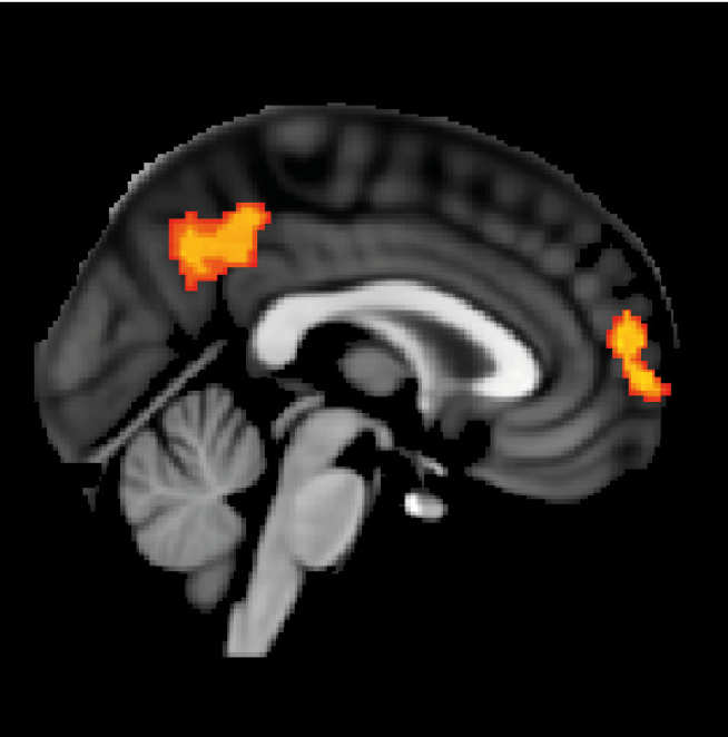 Abnormal brain activation