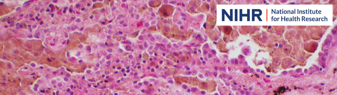 Close up microscopic image of tubercular lung tissue