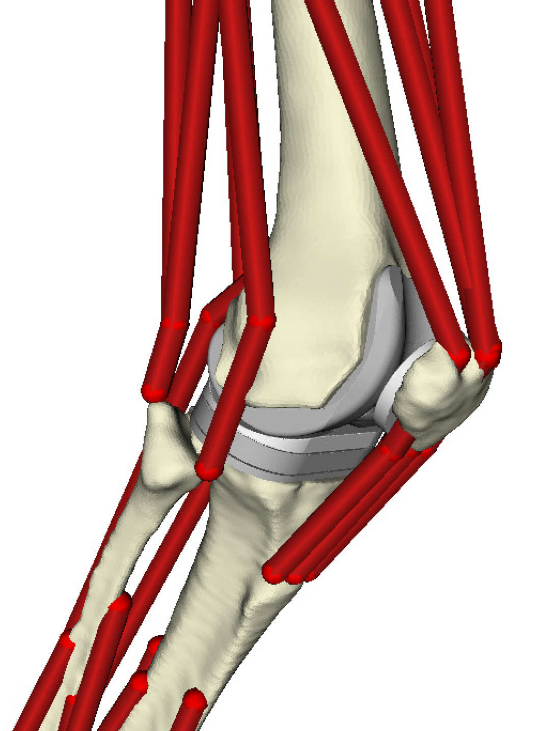simulation of total knee replacemnt