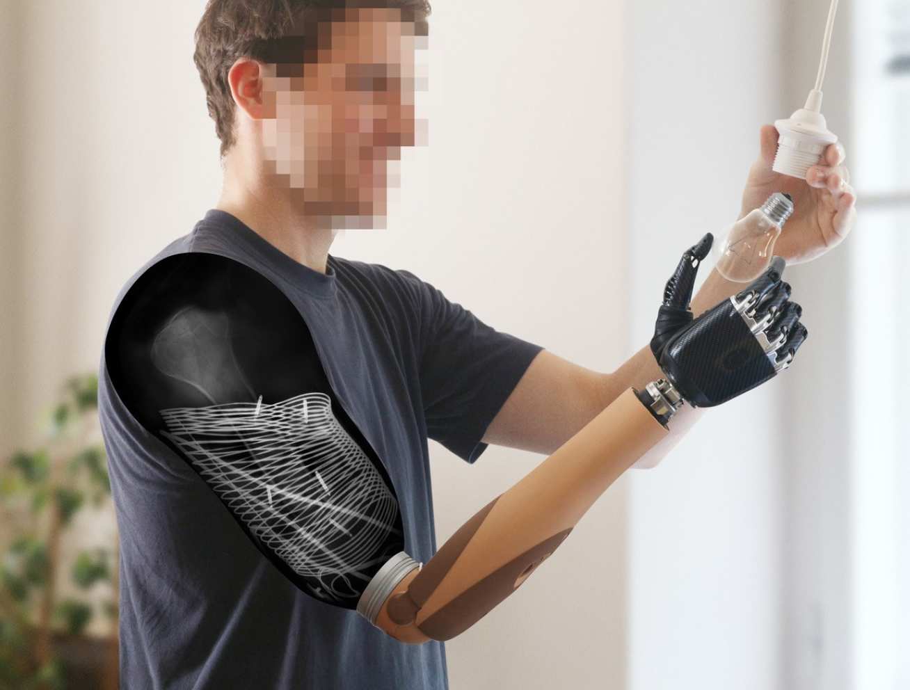 Photo of amputee using his prosthetic to fit a lightbulb. A cut-out shows the inner workings of the electrodes and nerve reinnervation