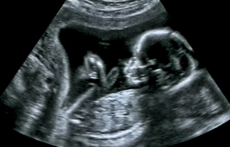Baby ultrasound scan image