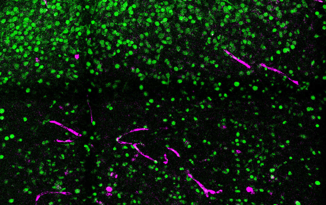 Transplanted human brain cells (green) and cell nuclei (purple)