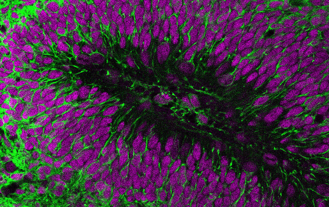 Transplanted human brain cells (green) and nuclei (purple).