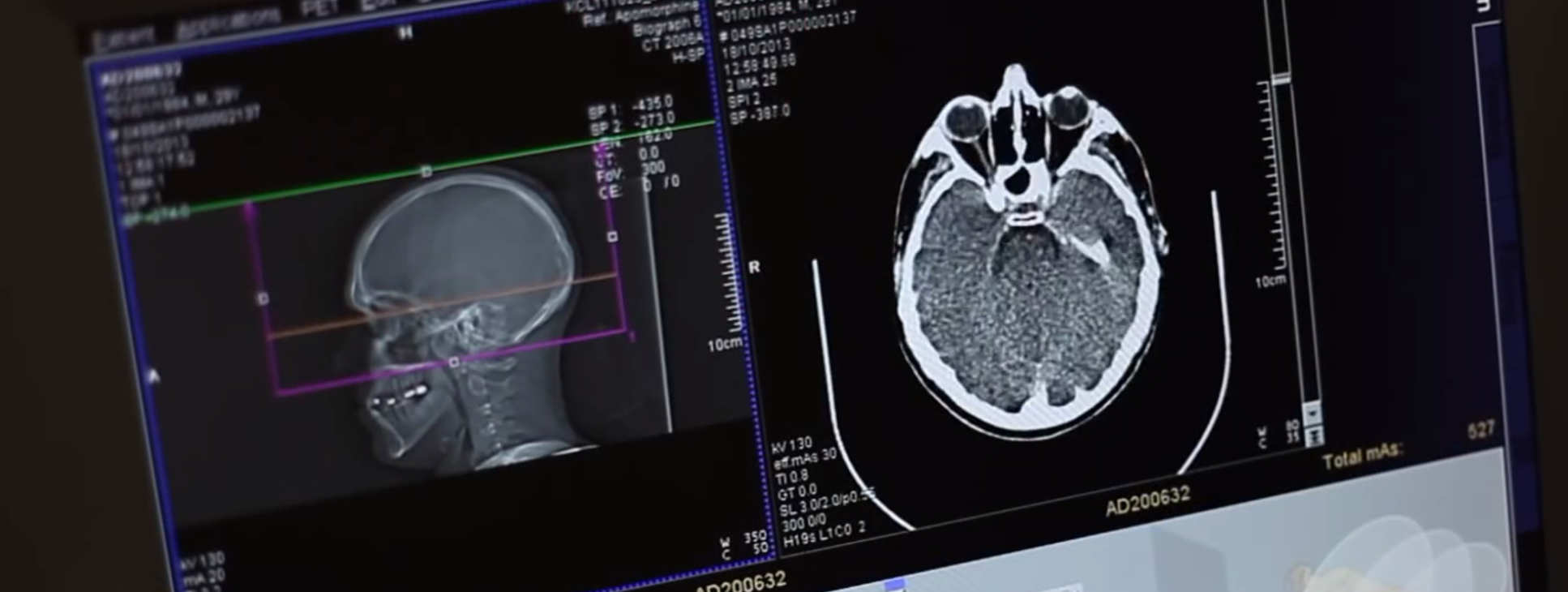 Brain MRI scan acquisition