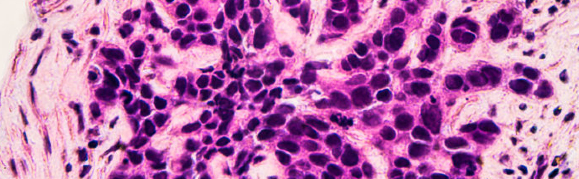 Biopsy of breast cancer