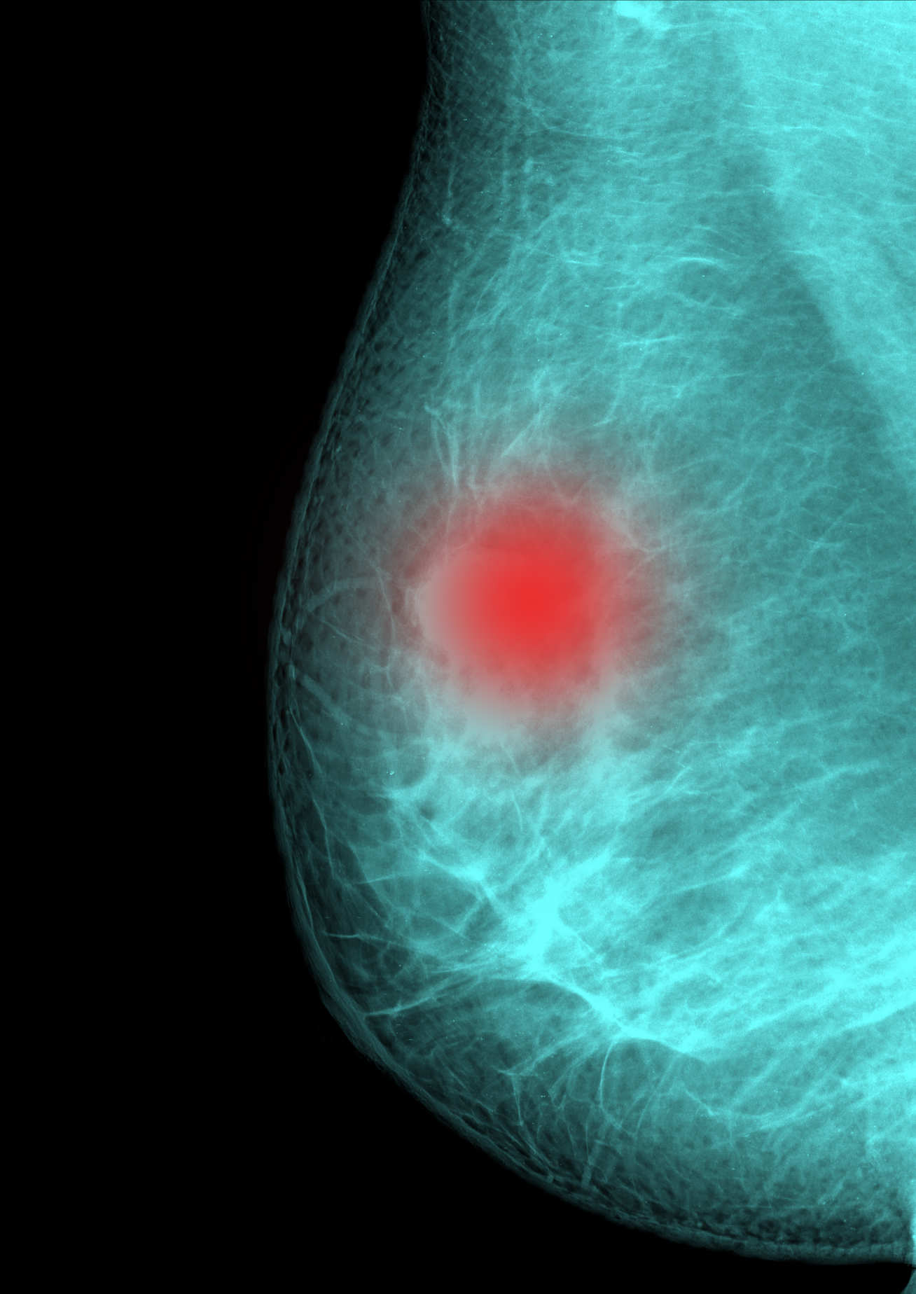 Up to one in five breast cancers are thought to be linked to faulty genes