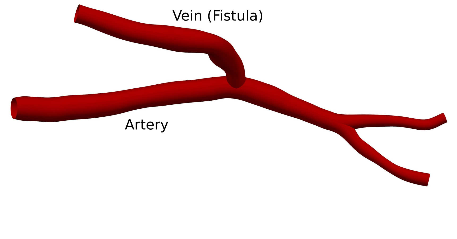 3D rendering of AVF with labels showing vein and artery