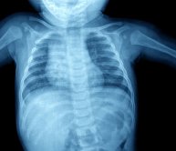 child chest xray