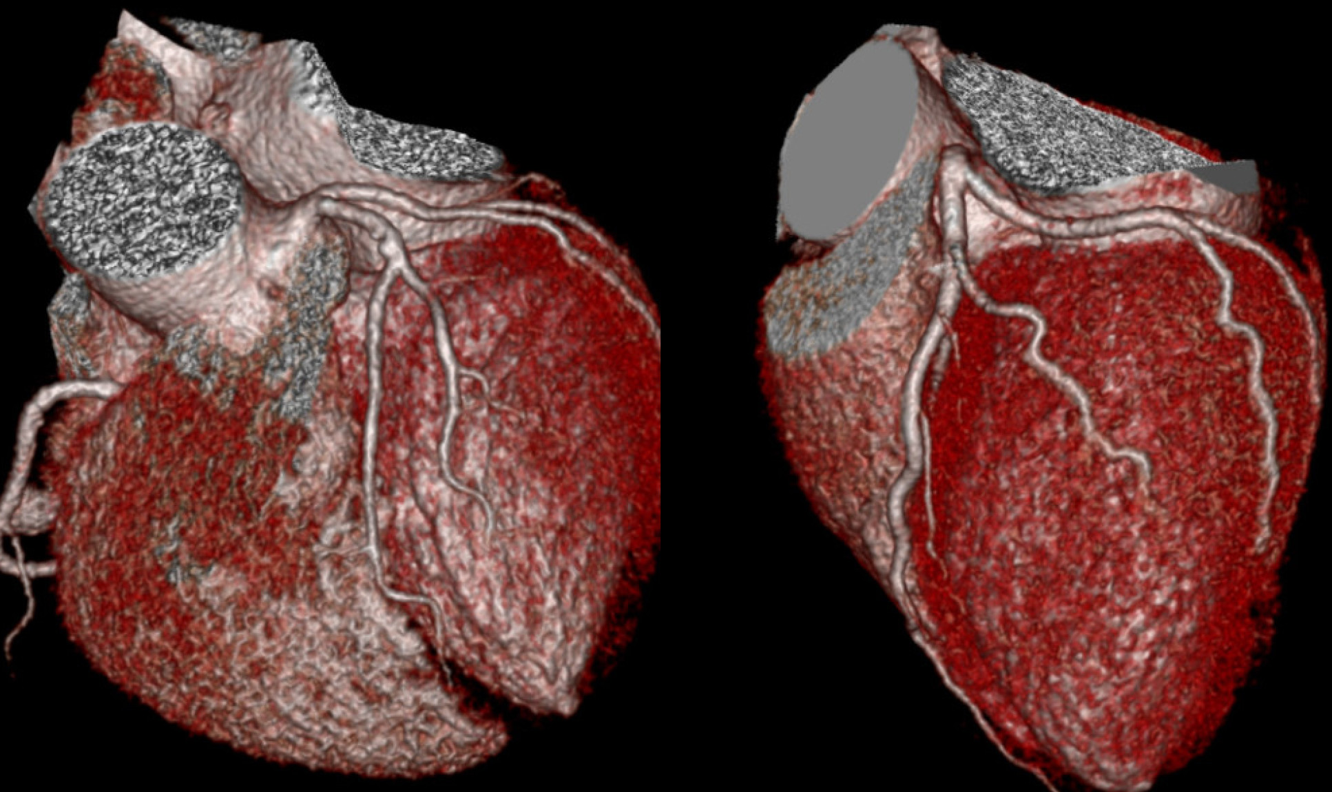 3D reconstruction of a healthy human heart and of the heart of a patient who suffers from DCM (CT scans).