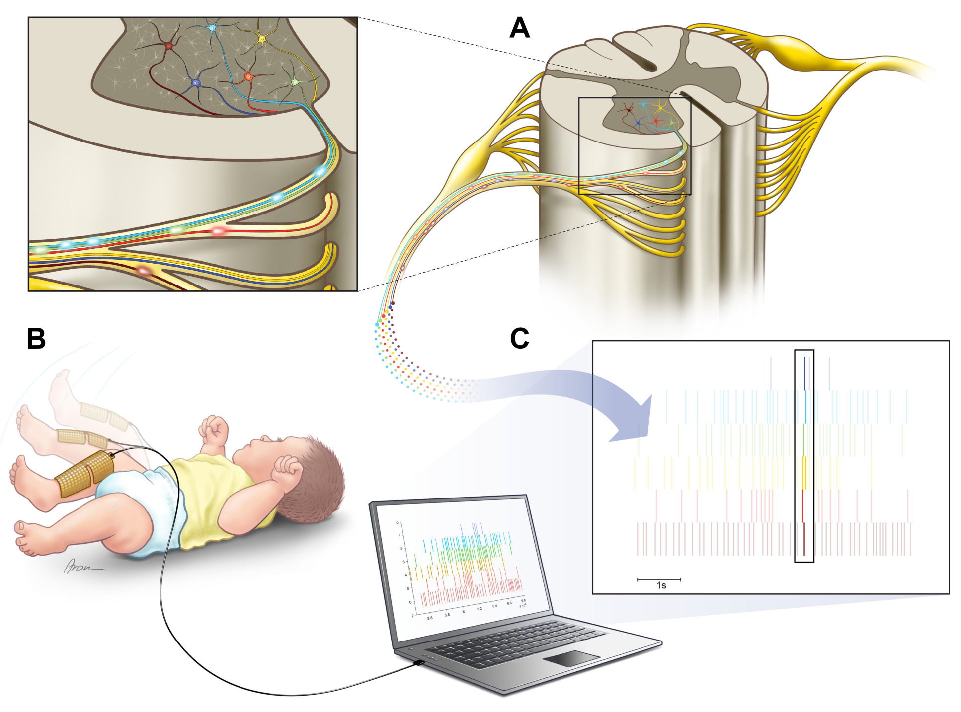 Diagram showing spinal cord neurons, how the cuff attaches to the baby, and the synchronisation of neurons during kicking