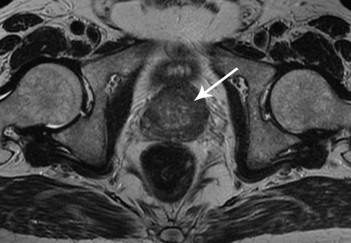 An MRI scan of prostate cancer