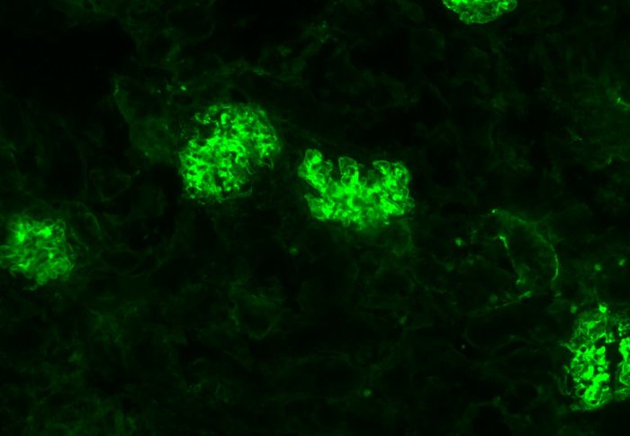 Immune cells (green) malfunctioning and attacking kidney cells