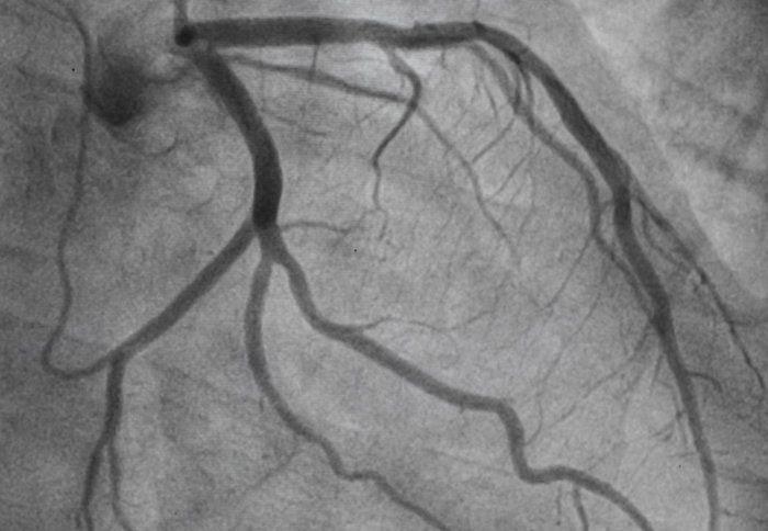 Coronary artery