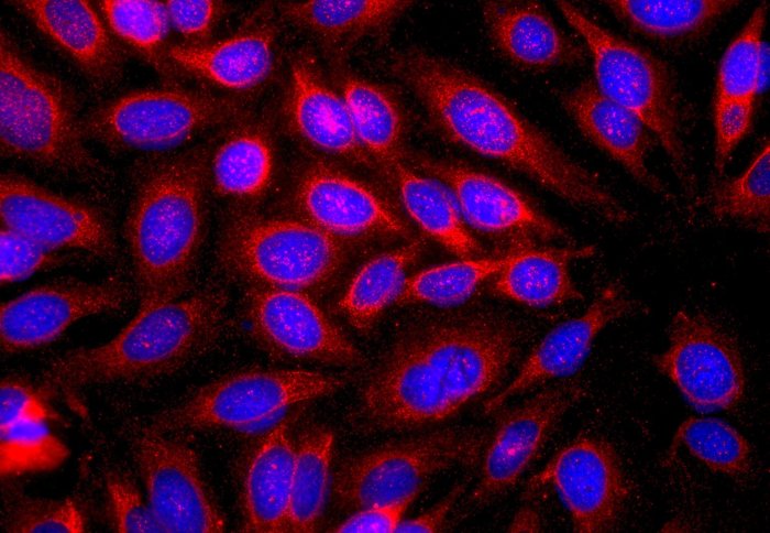 Human skin cancer cells (blue) with IgE bound to them (red)