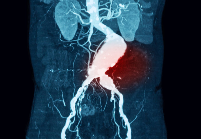 Abdominal aortic aneurysms