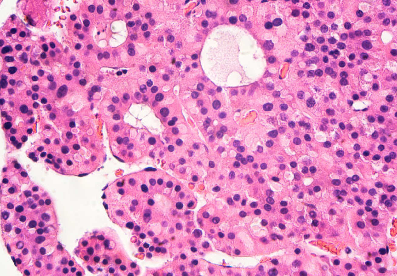 Liver cells with hepatocellular carcinoma (HCC)