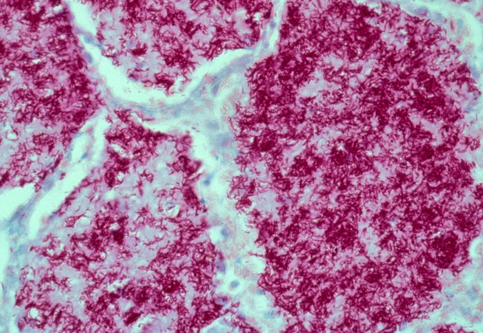 Lung: pulmonary tuberculosis