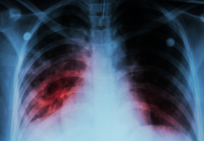 A chest X-ray of a patient with tuberculosis