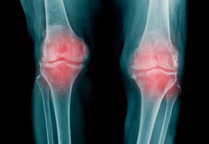 x-ray of a knee joint showing severe osteoarthritis in both knees