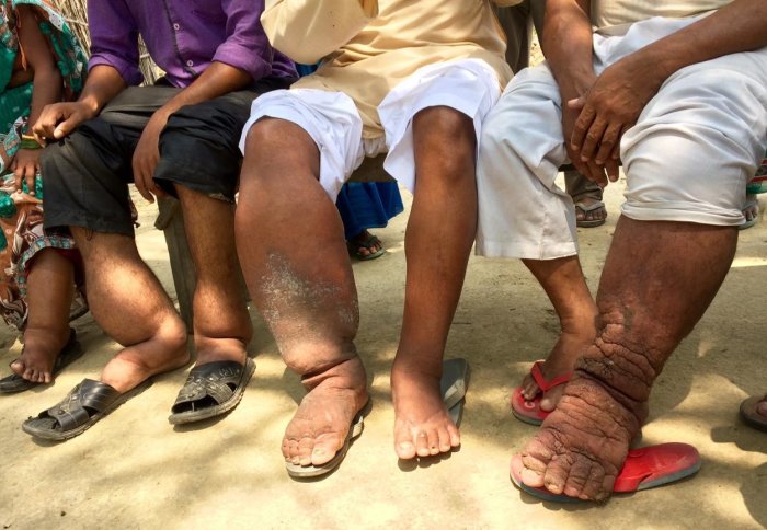Swollen lower legs of people with elephantiasis