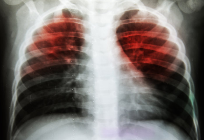 A chest x-ray showing pulmonary