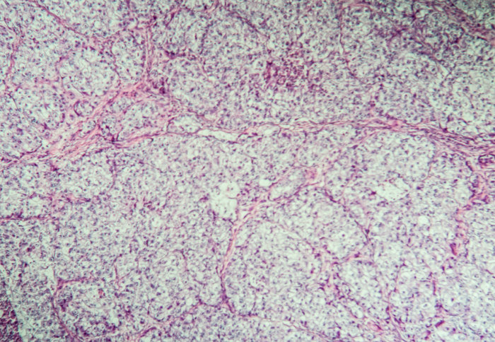 Ovarian cancer cells