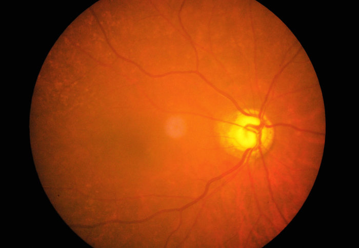 Retinal image of left eye in a 76 year old woman with glaucoma