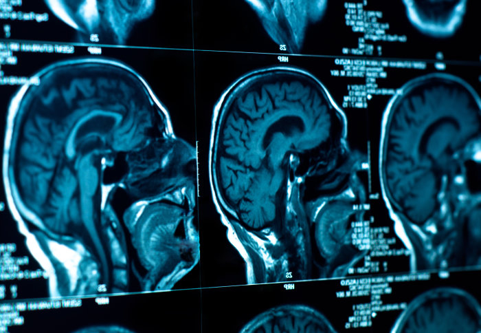 MRI brain scan