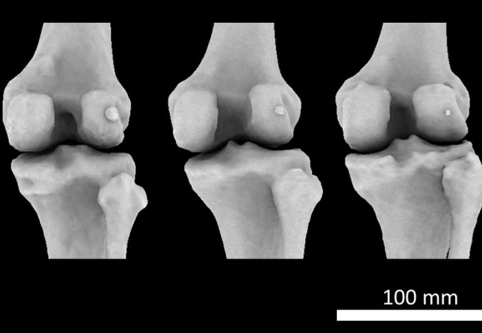 Scan of three knees, each showing different fabella sizes