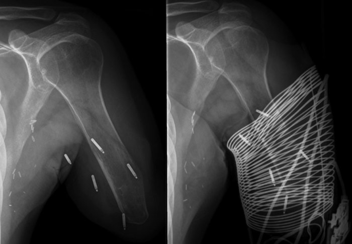 X-ray showing electrodes implanted in remaining arm in amputee patient