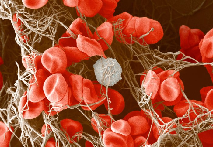 Colour-enhanced image of a blood clot. There are many red blood cells and a single white blood cell held together in a meshwork of fibrin (brown).