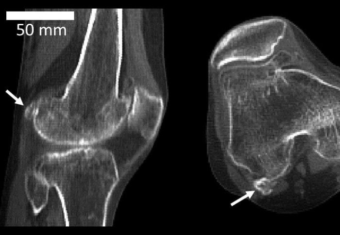 CT scan of two knees with the tiny fabella bones visible