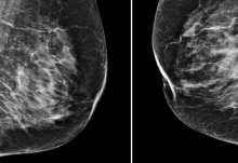 Artificial intelligence could help to spot breast cancer