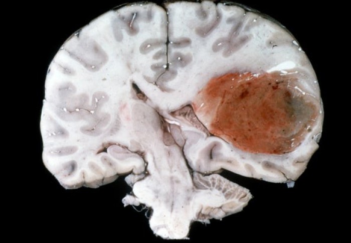 Section of brain affected by glioblastoma. The glioblastoma appears as a large dark red circle,