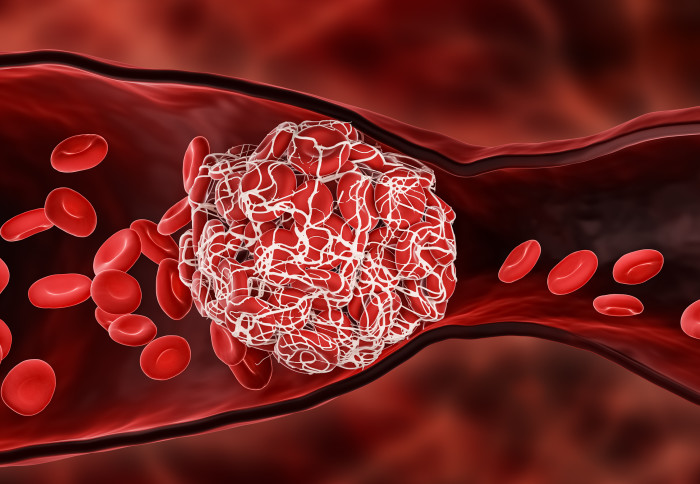 3D illustration of blood clot blocking a blood vessel entirely so that blood can no longer flow