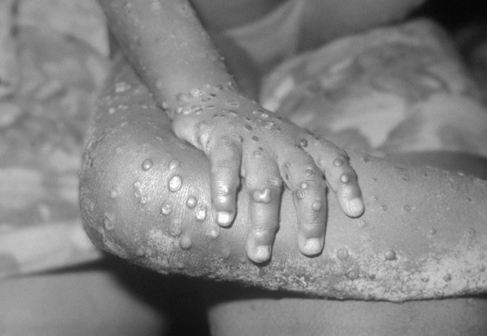 monkeypox lesions on the arm and leg of a female child
