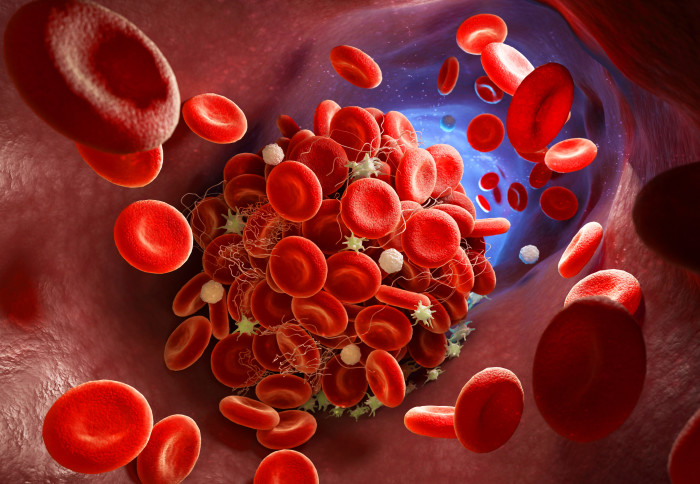 Illustration of a blood clot forming inside a blood vessel