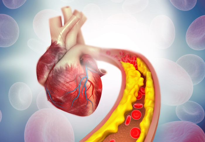 CGI picture of cholesterol plaque in artery