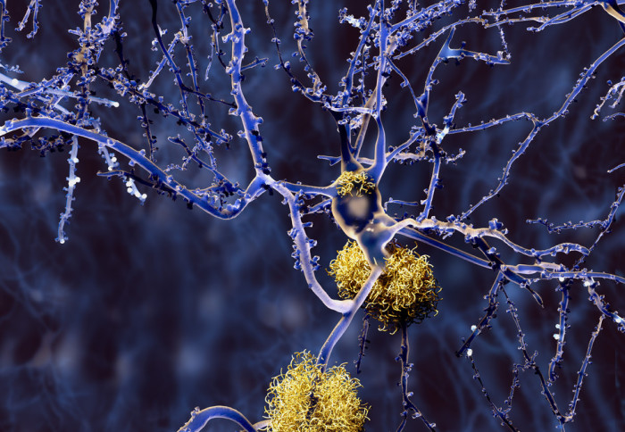 Alzheimer disease: neuron with amyloid plaques