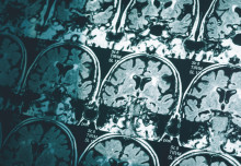 Single brain scan can diagnose Alzheimer’s disease